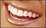 albirea dintilor | dinti albi prin gel de dintilor poate fi una dintre cele mai usoare cat si cele